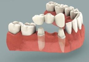 Dental bridges