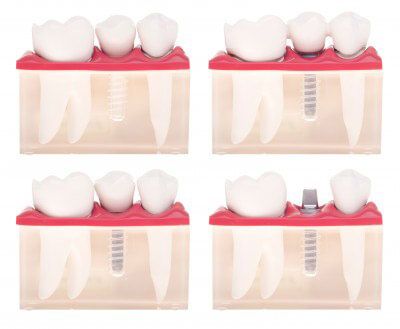 Dental implants